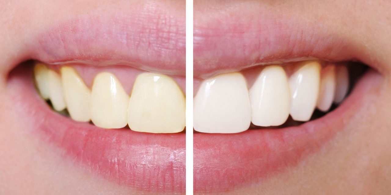 10 tips voor stralend witte tanden